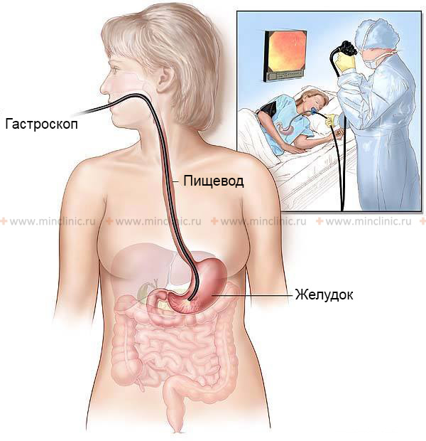 The gastroscopy procedure is performed in the endoscopy room.